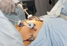 Gastric Band Revision Surgery