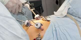 Gastric Band Revision Surgery