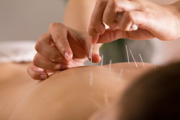 TCM Acupuncture