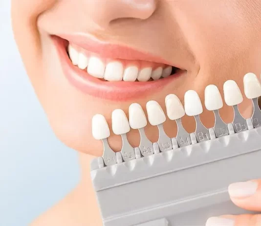 dental veneers