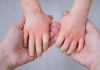 How NovaHealth Urgent Care Treats Hand, Foot, and Mouth Disease