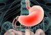 Hypochlorhydria: Understanding the Real Impact of Low Stomach Acid